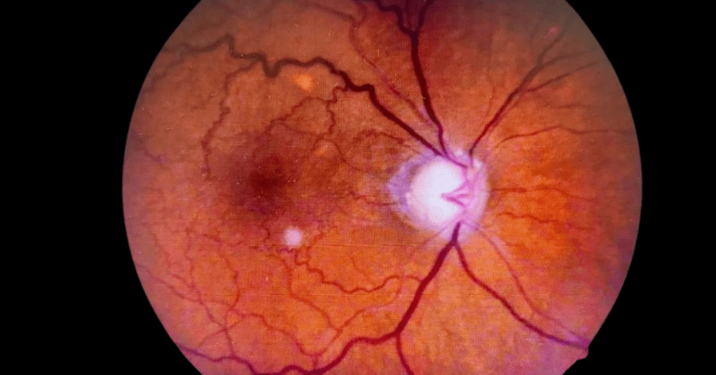 Ceguera silenciosa: Conozca el Glaucoma una enfermedad irreversible que le hace perder la&nbsp;vista